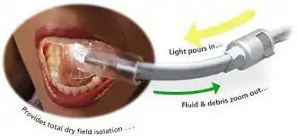 Diagram of Isolite dental technology