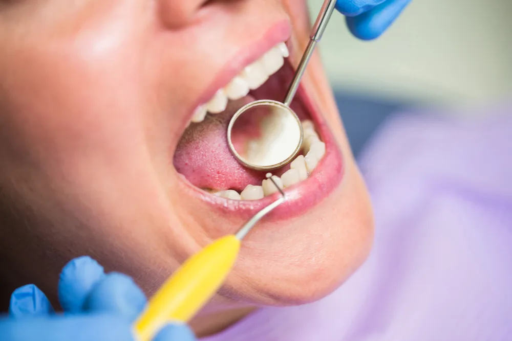 Dentist examining a patient's teeth with a mouth mirror during a dental exam