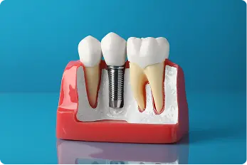 Dental Implants model